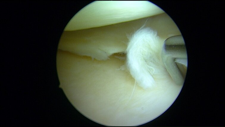 006 flapscheur meniscus klein