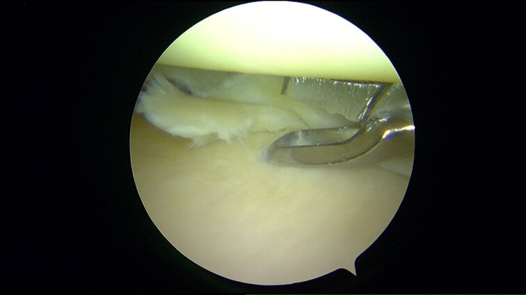 008 wegknippen gescheurde meniscus klein