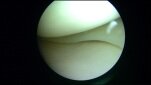 004 mediale meniscus mini