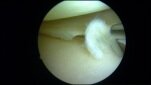 006 flapscheur meniscus mini